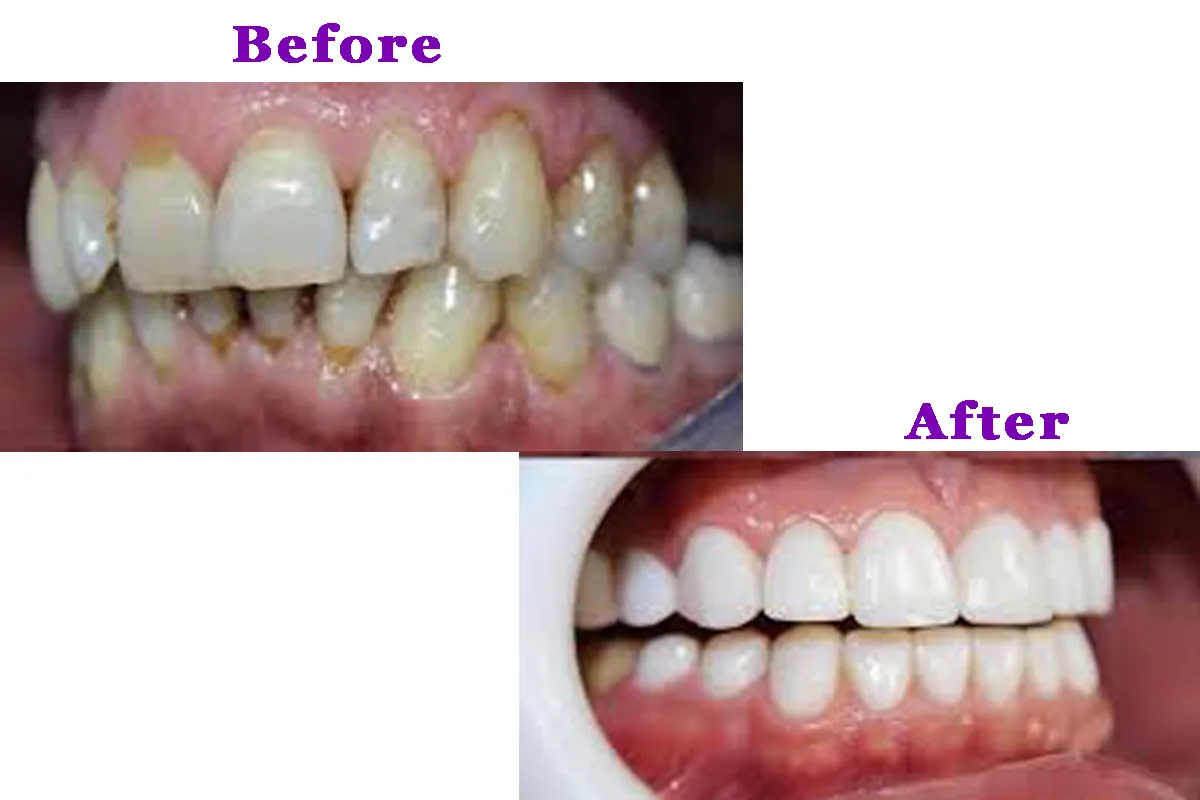 Smile Restoration & Whitening — before and after
