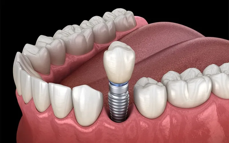 Dental Implants vs Dentures: Which Is Right for You?